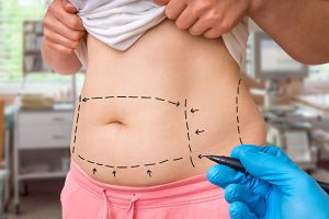 Um Guia Completo para Pós-Lipoaspiração Tranquila