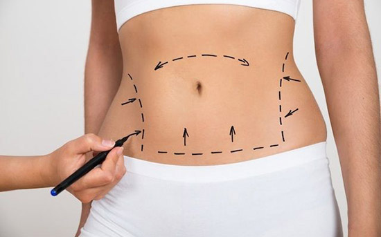 Abdominoplastia em adolescentes