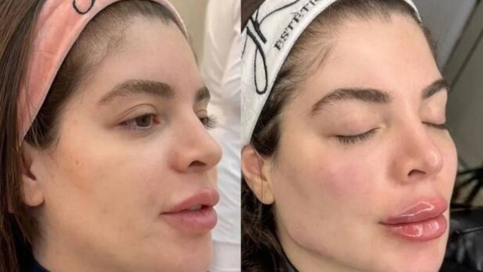 Famosos Que Já Fizeram Harmonização Facial