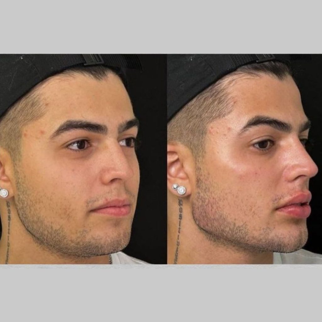 Famosos Que Já Fizeram Harmonização Facial