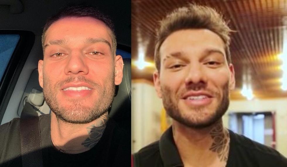 Famosos Que Já Fizeram Harmonização Facial