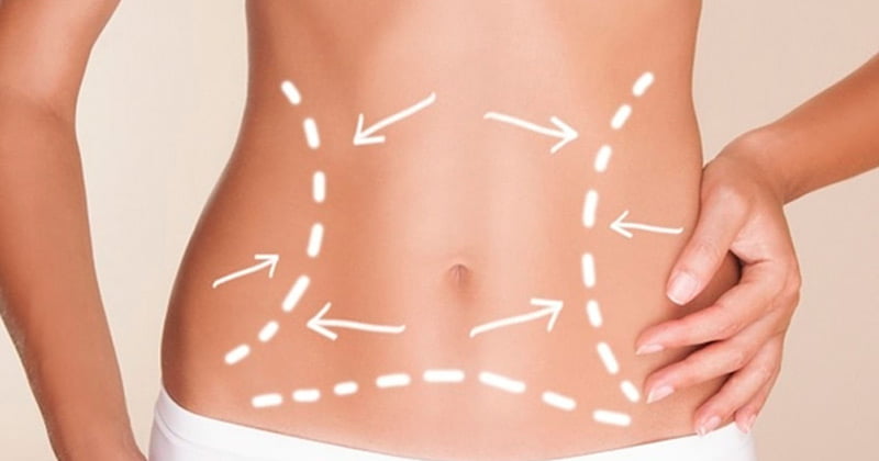 Abdominoplastia em adolescentes