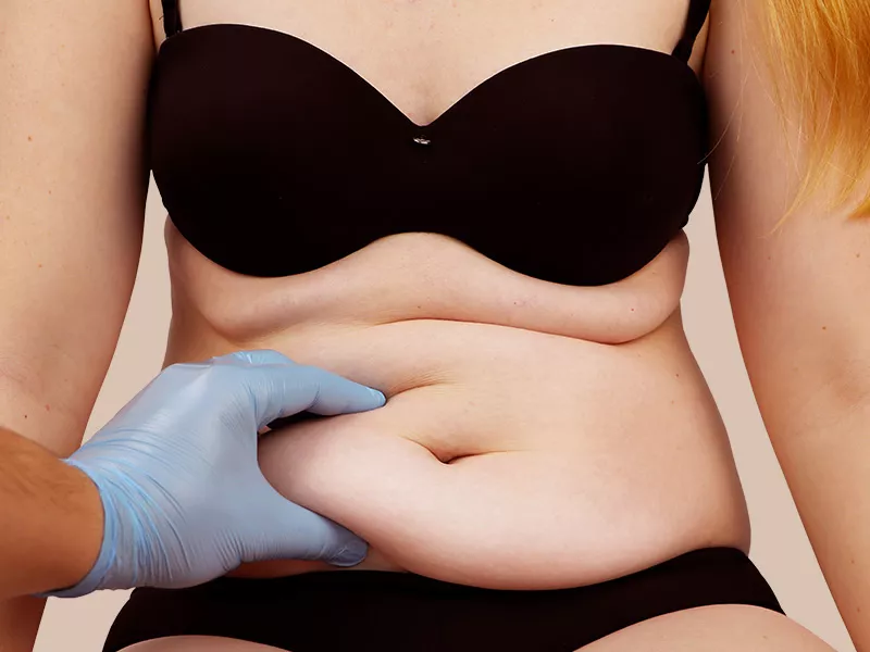 Abdominoplastia em adolescentes