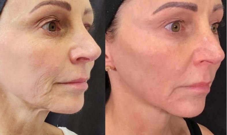 Descubra os benefícios do tratamento Morpheus