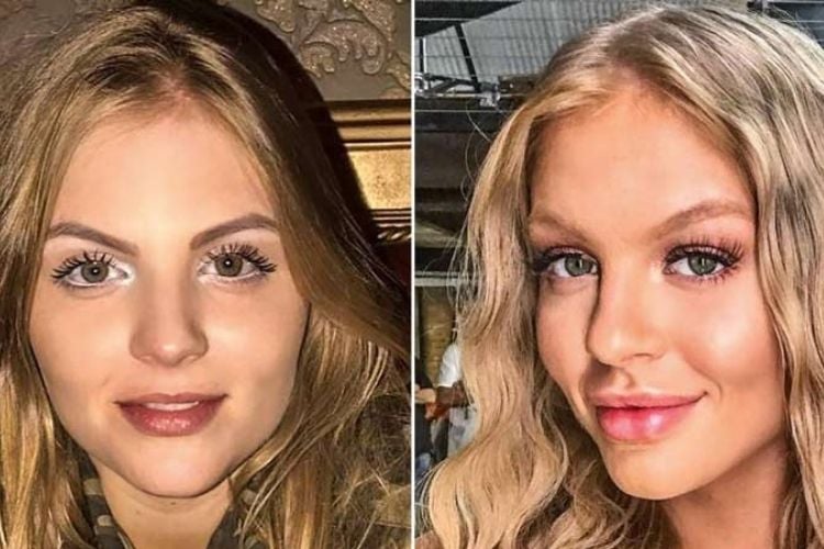 Harmonização facial: como é feito o procedimento? Veja antes e depois dos  famosos! | Fashion Bubbles