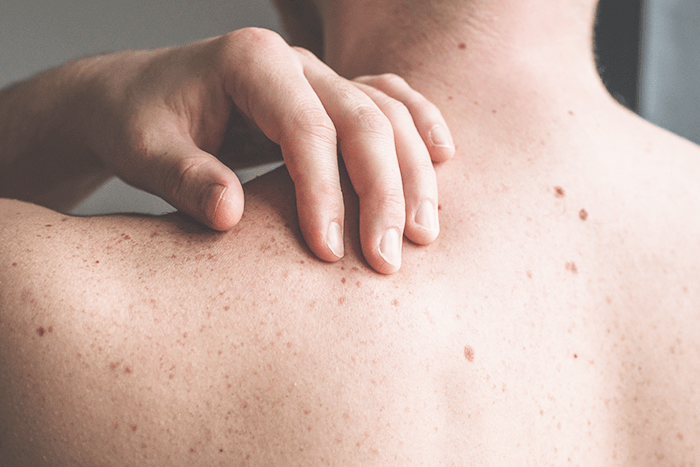 MaisPB • Campanha contra câncer de pele começa a partir de amanhã em  Campina Grande