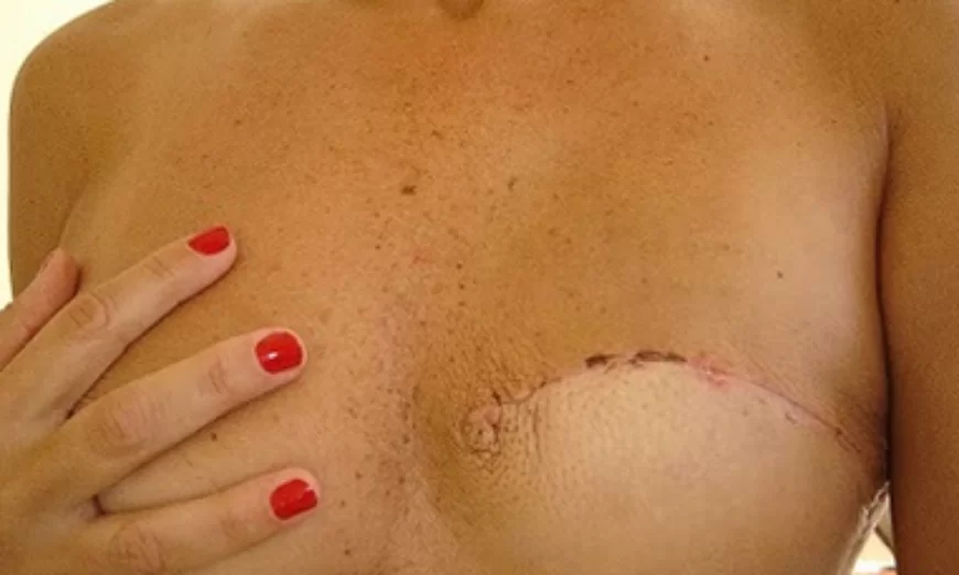 Importância da Fisioterapia nas Mulheres Mastectomizadas - Clínica Fortius