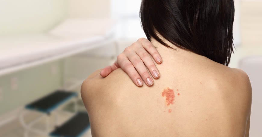 Anvisa registra remédios inovadores para câncer de pele - Biored Brasil